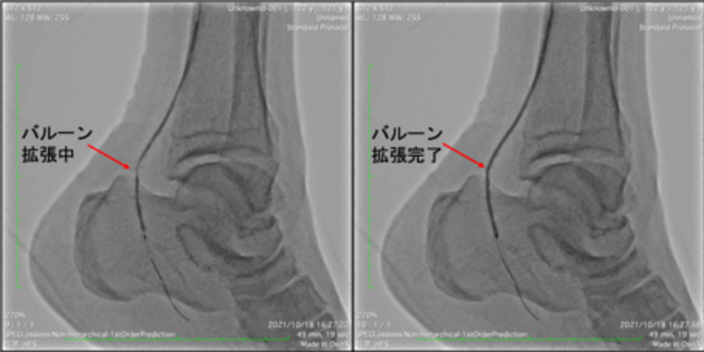 足部の血管内カテーテル治療