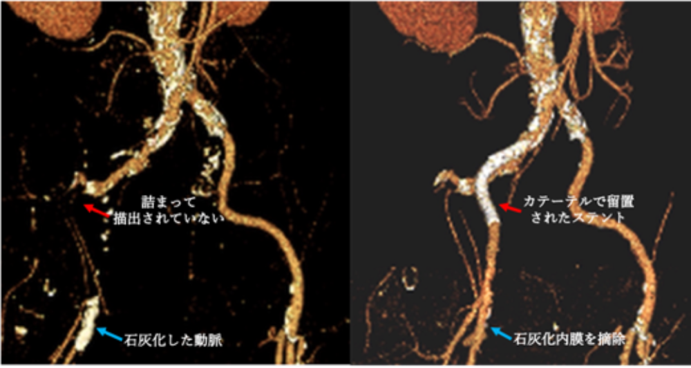 腹部には血管内カテーテル治療・大腿部には外科的血行再建（血栓内膜摘除術）を行ったハイブリット手術