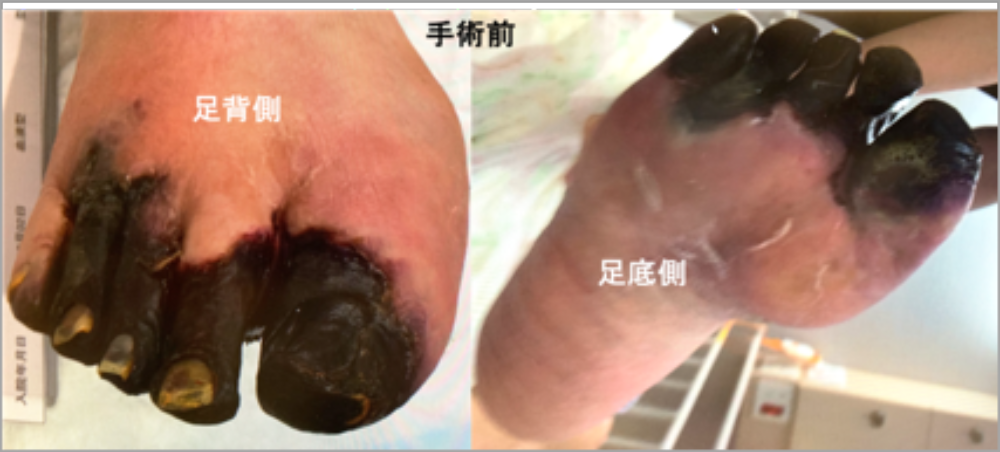 血管内カテーテル治療＋中足骨離断術